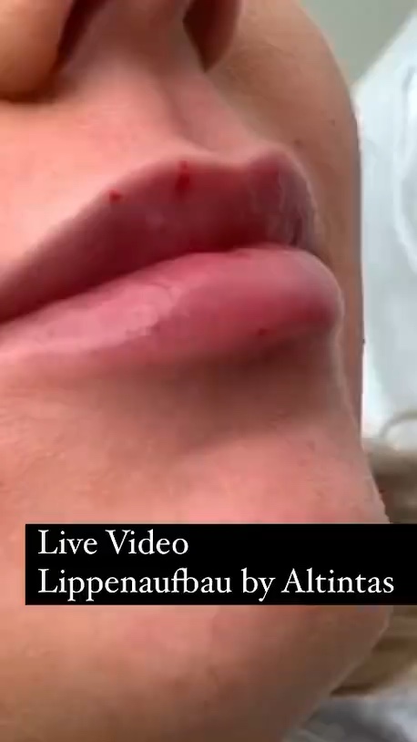 Nahaufnahme der Lippen mit sichtbaren Einstichstellen