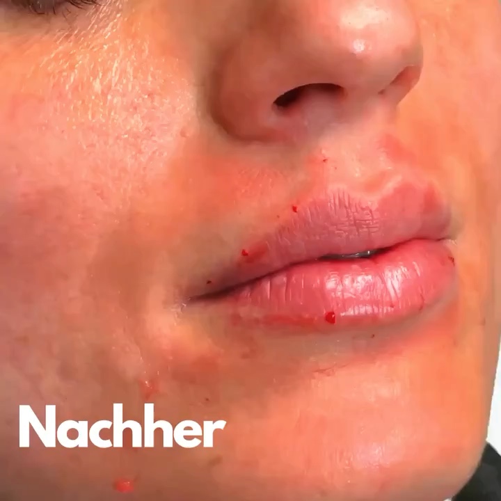 Nahaufnahme der Lippen mit sichtbar erhaltenen Behandlungsspuren