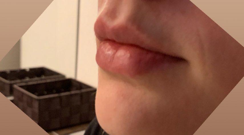 Natürliches Ergebnis Lippen aufspritzen 