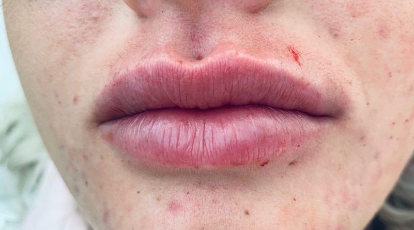 Wie teuer ist eine Lippen Behandlung?