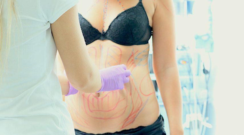 Vorbereitung einer Brustvergrößerung mit Implantaten 