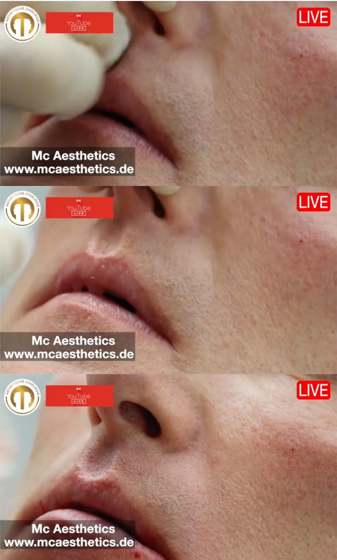 Lippen Vergrossern Moglichkeiten Mc Aesthetics Koln