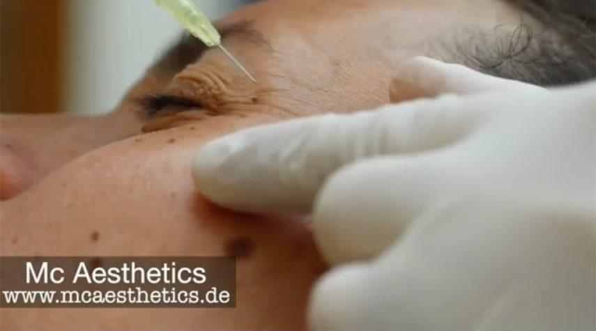 Krähenfüße Botox Augenringe entfernen Königswinter