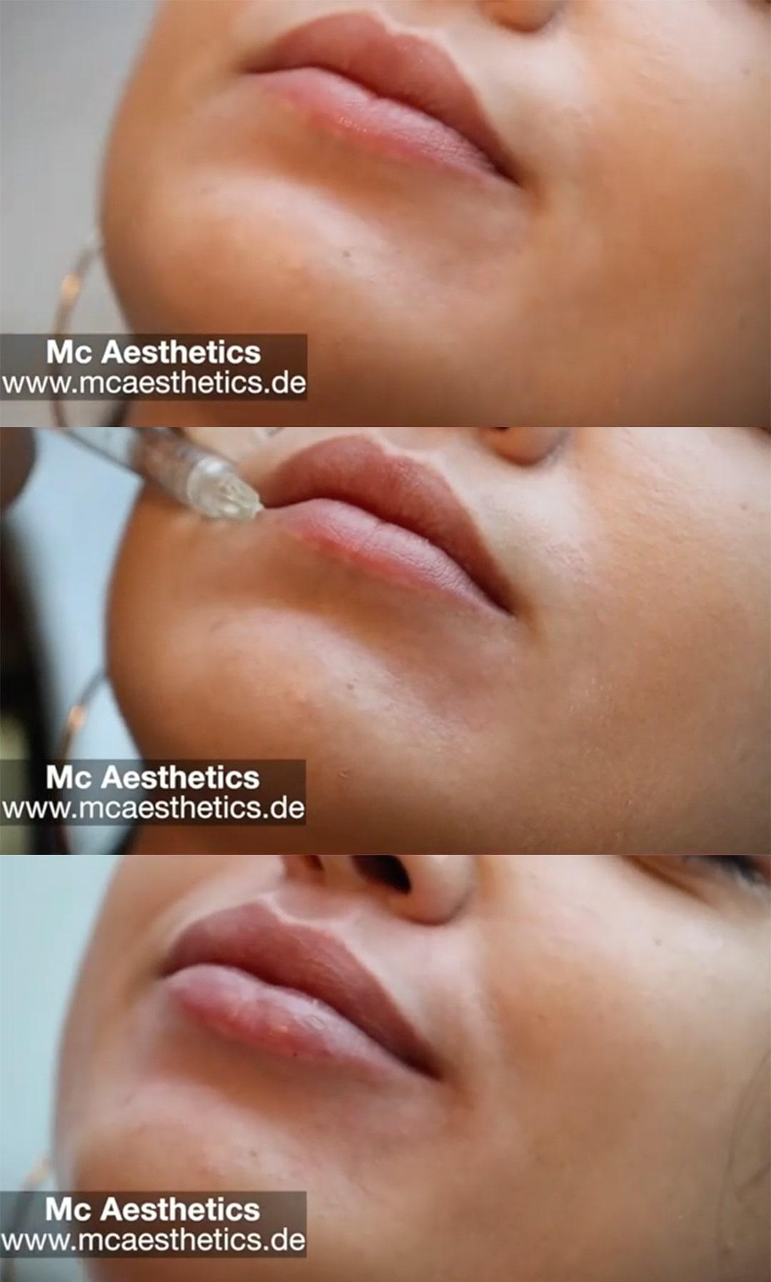 Lippen Aufspritzen Ohne Schmerzen Lippen Aufspritzen Ohne Schmerzen