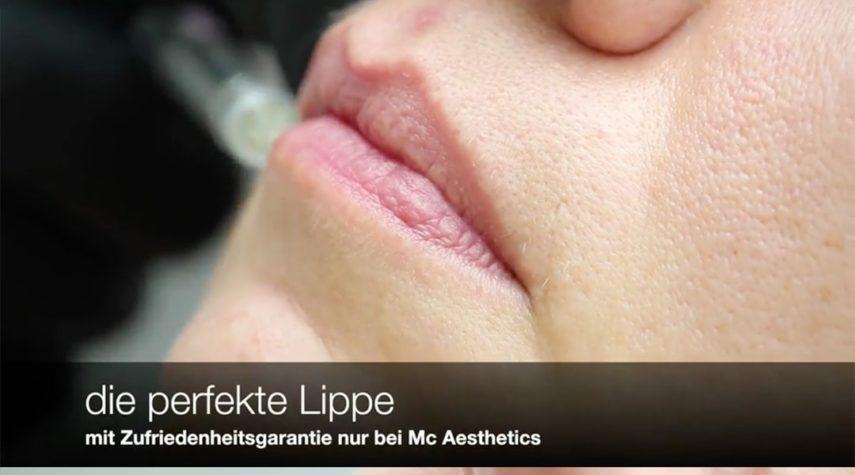 Lippen unterspritzen