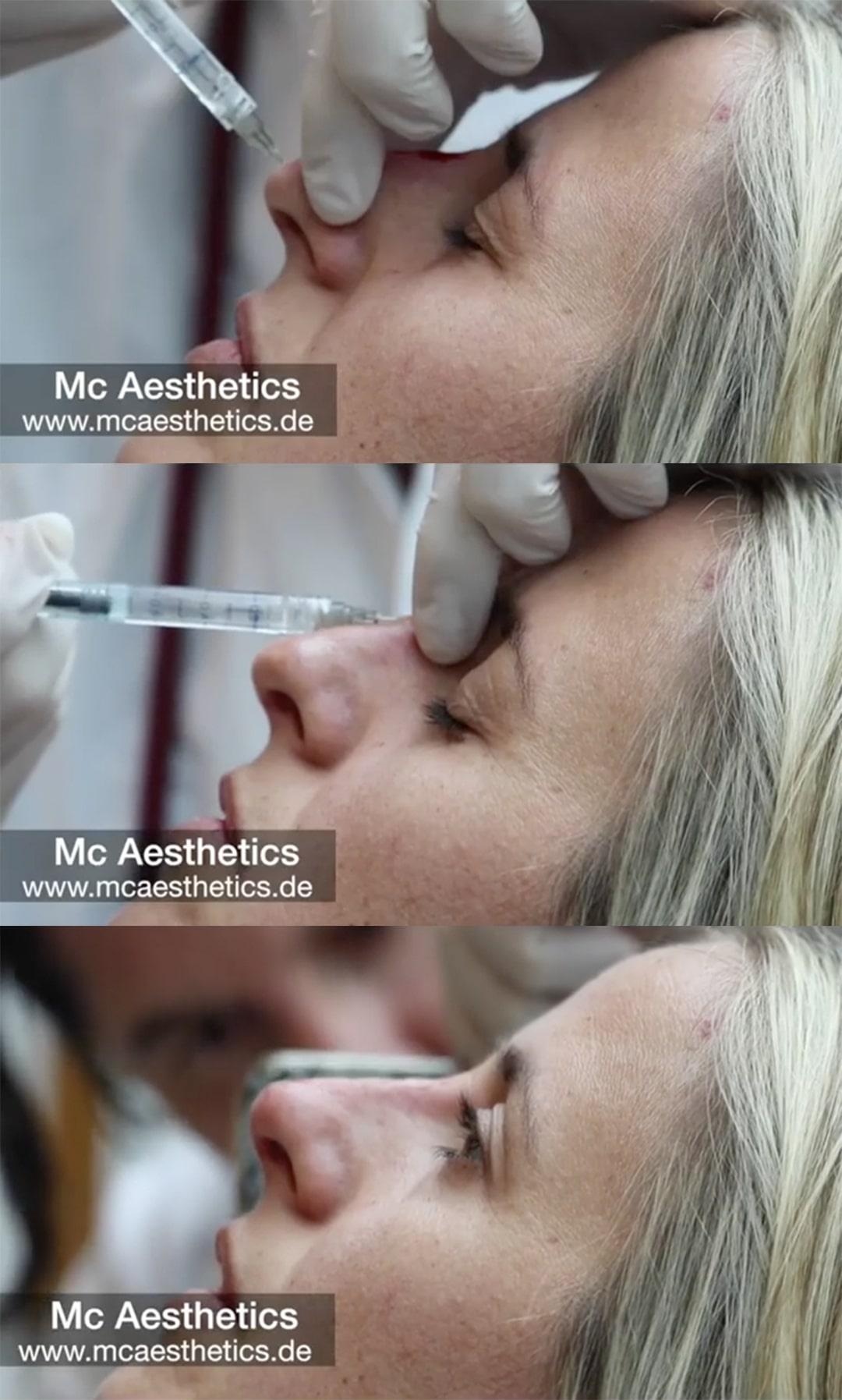 Wie Kann Ich Meine Nase Kleiner Machen Ohne Op Mc Aesthetics